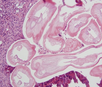 Figure B: Cross-sections of <em>Dirofilaria</em> spp. from a subcutaneous scalp nodule, stained with H&E. Image courtesy of the Department of Dermatopathology, University of Michigan, Ann Arbor, MI.