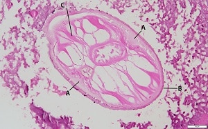 Figure A: Cross-section of <em>Dirofilaria tenuis</em> from a subcutaneous nodule in a patient from Florida. Note the internal lateral ridge (A); multi-layered, ridged cuticle (B); and tall musculature (C). This specimen is somewhat degenerated, a common finding in dirofilariasis cases. 