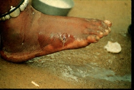 Figure B: after rupture of the blister, the worm emerges as a whitish filament in the center of a painful ulcer which is often secondarily infected. (Images contributed by Global 2000/The Carter Center, Atlanta, Georgia). 
