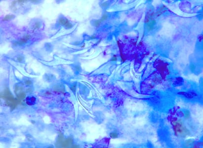 Figure F: Free hooklets in 'hydatid sand' from the aspirate of a liver cyst, stained with PAP.