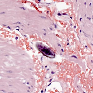 Figure F: Egg of <em>E. vermicularis</em> in a colon biopsy specimen, stained with H&E.