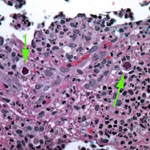 Figure E: Cysts of <em>Acanthamoeba</em> sp. (green arrows) in tissue, stained with H&E.