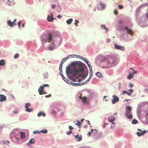 Figure C: Cyst of <em>Acanthamoeba</em> sp. from brain tissue, stained with hematoxylin and eosin (H&E).