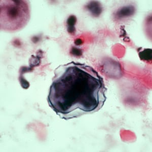 Figure D: Cyst of <em>Acanthamoeba</em> sp. from brain tissue, stained with hematoxylin and eosin (H&E).