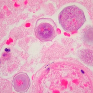 Figure H: Cysts of <em>B. mandrillaris</em> in brain tissue, stained with H&E. Image courtesy of Cook Children’s Hospital, Fort Worth, Texas.