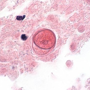 Figure F: Cyst of <em>B. mandrillaris</em> in brain tissue, stained with H&E. Image courtesy of the University of Kentucky Hospital, Lexington, Kentucky.