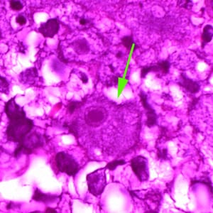 Figure F: A single trophozoite (green arrow) of <em>B. mandrillaris</em> in brain tissue, stained with H&E.