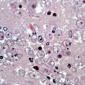 Figure E: Several trophozoites of <em>B. mandrillaris</em> in brain tissue, stained with hematoxylin and eosin (H&E).