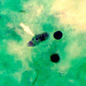 Figure E: Trophozoite of <em>N. fowleri</em> in CSF, stained with trichrome. Image courtesy of the Texas State Health Department.