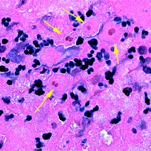 Figure F: Four trophozoites (yellow arrows) of <em>S. pedata</em> in brain tissue, stained with hematoxylin and eosin (H&E). In three of the amebae, the two nuclei can easily be seen.