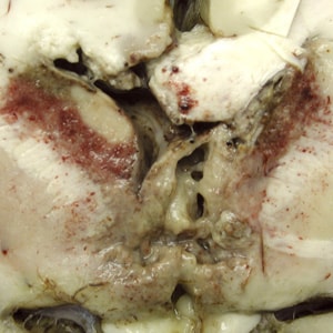 Figure B: Gross specimen of brain tissue from a patient who died of granulomatous amebic encephalitis (GAE) caused by <em>Balamuthia mandrillaris</em>. The autopsy specimen revealed extensive necrotizing (mixed inflammatory, occasional giant cells, vasculitic) granulomatous encephalitis with a subependymal necroinflammatory process. Image courtesy of Cook Children’s Hospital, Fort Worth, Texas.