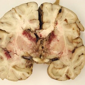 Figure A: Gross specimen of brain tissue from a patient who died of granulomatous amebic encephalitis (GAE) caused by <em>Balamuthia mandrillaris</em>. The autopsy specimen revealed extensive necrotizing (mixed inflammatory, occasional giant cells, vasculitic) granulomatous encephalitis with a subependymal necroinflammatory process. Image courtesy of Cook Children’s Hospital, Fort Worth, Texas.