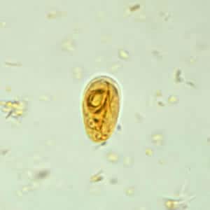 Giardia-fertőzés (giardiasis) Giardiasis hordozó