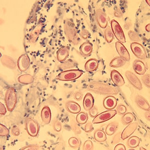 Figure D: Eggs of <em>C. hepatica</em> in liver stained with H&E.