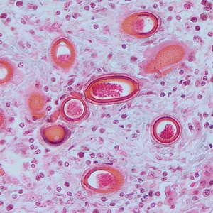 Figure C: Eggs of <em>C. hepatica</em> in liver stained with H&E.