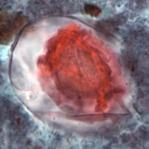 Figure B: Egg of <em>H. nana</em> in a trichrome-stained stool specimen. Although trichrome is not the preferred method for observing helminth eggs, they can be detected this way. The eggs are distorted, probably due to the zinc polyvinyl alcohol (PVA) used for preserving specimens for trichrome stain. Images courtesy of the Oregon State Public Health Laboratory.