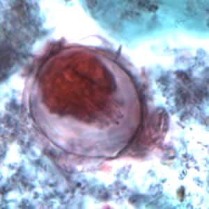 Figure A: Egg of <em>H. nana</em> in a trichrome-stained stool specimen. Although trichrome is not the preferred method for observing helminth eggs, they can be detected this way. The eggs are distorted, probably due to the zinc polyvinyl alcohol (PVA) used for preserving specimens for trichrome stain. Images courtesy of the Oregon State Public Health Laboratory.