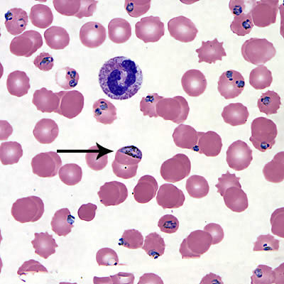 Malaria case study presentation image