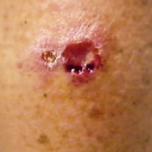 A 42-year-old animal trapper sought medical attention regarding an ulcerative lesion on his arm (Figure A). He reported that he had been in Bolivia two months ago and that the lesion on his arm had grown worse since his return. A biopsy of the lesion on his arm was performed and a touch prep smear prepared and stained with Giemsa.
