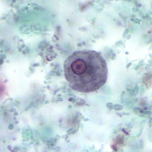A 45-year-old woman went to her physician with complaints of recurring abdominal cramping, bloating, and infrequent diarrhea. Her travel history included a 10-day camping trip in Alaska, and her symptoms had started approximately 2 weeks after her return. Her physician ordered an ova and parasites (O & P) examination. 