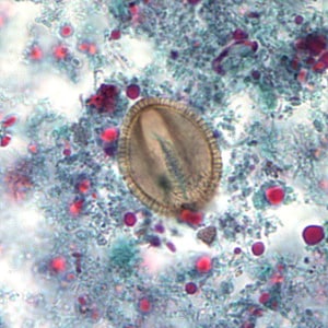 A 28-year-old man complained of gastrointestinal pain and bloating. At the request of his health care provider, he submitted a fecal specimen preserved in low viscosity polyvinyl alcohol (LV-PVA). A trichrome stained smear was made from some of the specimen. 