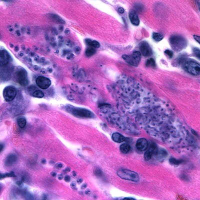 A CDC microbiologist was looking through slide boxes that had been archived to determine whether the slide quality was good enough to continue storing them. He came across a pathology slide of heart tissue that was dated 