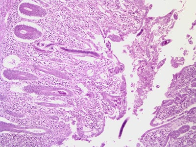 A 49-year-old Filipino man had an intestinal tissue biopsy taken. Figures A-C show what was seen on slides stained with hematoxylin and eosin (H & E). 