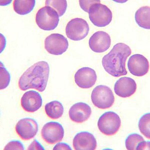 A 30-year-old man from Sudan had fever and chills. He was also mildly jaundiced. He went to his physician who ordered a blood smear examination. 