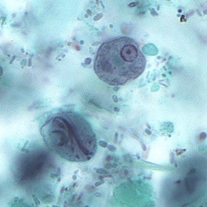 Images captured from a trichrome stained smear were submitted to DPDx for diagnostic assistance. The smears were made from a polyvinyl-alcohol (PVA) preserved fecal specimen, but no other patient or specimen information was given. 