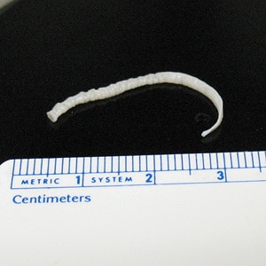 A small, cream-colored worm-like object was discovered in the diaper of a 15-month-old child. The suspect worm was collected by the child’s parents and sent to the State Health Department for identification. 