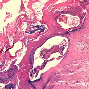 An 80-year-old resident of a long-term care facility presented with a skin condition manifesting as thick crusts over the skin accompanied by slight itching. The patient was originally treated for impetigo, with no resolution, and was ultimately admitted to the hospital for further testing. 