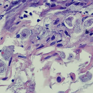 A biopsy was performed on a 23-year-old woman with no known travel history, presenting with a perianal ulcer. The specimen was preserved in formalin and sent to a pathology lab for work-up.