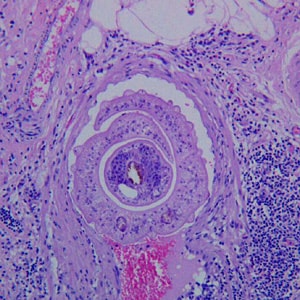 A 35-year-old male from the United Arab Emirates was hospitalized with complaints of upper and lower abdominal pain. Sections of the greater omentum and appendix were biopsied and sent to a pathology laboratory for sectioning and staining. 