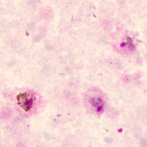 A 33-year-old woman, who had traveled to Togo and Benin for two weeks, developed fever, chills, and rigors within three days after returning to the U.S. 