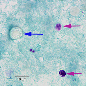 cdc case study answers ovarian