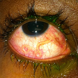 A 27-year-old male from Cameroon, who immigrated to the U.S. six years ago, presented to his health care provider with ocular pain and swelling. He told his health care provider that he had an episode of "a worm crawling in his eye" three years prior. 