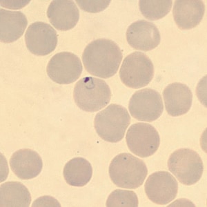 A 50-year-old man from Cambodia was admitted to the hospital for recurrent fevers. Blood specimens were collected in EDTA and sent to Hematology for routine work-up. 