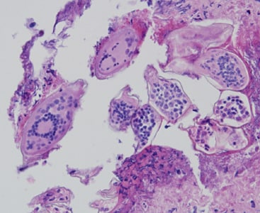 A 58-year-old female who had emigrated from Africa was seen by her health care provider for complications with squamous cell carcinoma of the cervix. 
