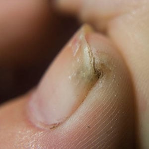A 25-year-old woman traveled to Kenya and Uganda for three months of field work in public health entomology. Upon returning to the United States, she noticed a painful lesion on her left big toe.