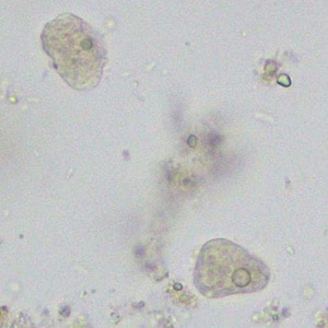 A state health laboratory received stool specimens collected in in sodium acetate-acetic acid-formalin (SAF) for ova-and-parasite (O&P) examination. The patient was an immigrant, but his specific country of origin was not known.