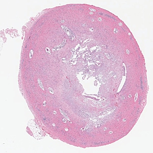 A 73-year-old woman presented to a local clinic in Ghana with a skin nodule that had developed adjacent to the resection site of a previous low-grade malignant skin tumor. 