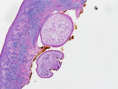 A 71-year-old female presented to her health care provider with a nodule on her back. The nodule was removed and sent to Pathology for histological work-up. 