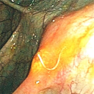 A 23-year-old female with no documented travel history presented with iron deficiency anemia and periodic abdominal pain. Ova-and-parasite (O&P) examinations of stool were negative.