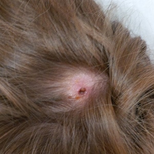 A six-year-old boy from Washington, D.C. presented with a non-migratory furuncle on his scalp several weeks after returning from a trip to Belize (Figures A and B).