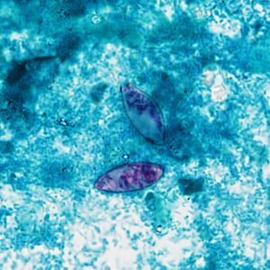 A 25-year-old refugee from Myanmar had a stool specimen collected for routine ova-and-parasite examination as part of a post-arrival screening.