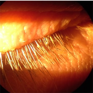 An adult patient with right eye and eyelid irritation sought medical attention at an eye clinic. Upon examination, living organisms and what appeared to be egg cases were identified on the patient's eyelids and eyelashes. 