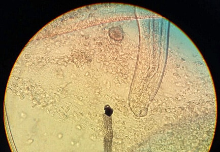 A patient, who lives in a rural region in South America, presented with bloody diarrhea and remembers having eaten undercooked pork. The attending physician submitted images to the DPDx Team of a roundworm he observed during a colonoscopy. 