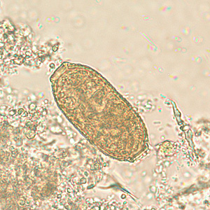 Capillaryasis Capillariasis