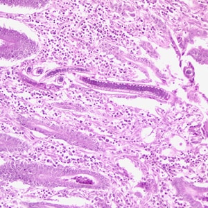 Figure C: Longitudinal section of an adult <em>C. philippinensis</em> from an intestinal biopsy specimen, stained with H&E.