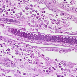 Capillaryasis CDC - DPDx - Intestinal Capillariasis